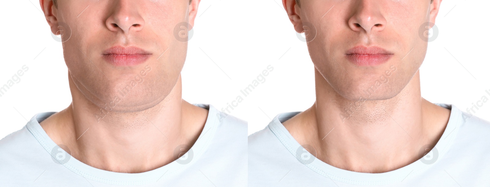 Image of Double chin problem. Collage with photos of man before and after plastic surgery procedure on white background, closeup. Banner design