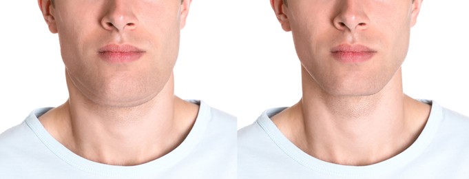 Image of Double chin problem. Collage with photos of man before and after plastic surgery procedure on white background, closeup. Banner design