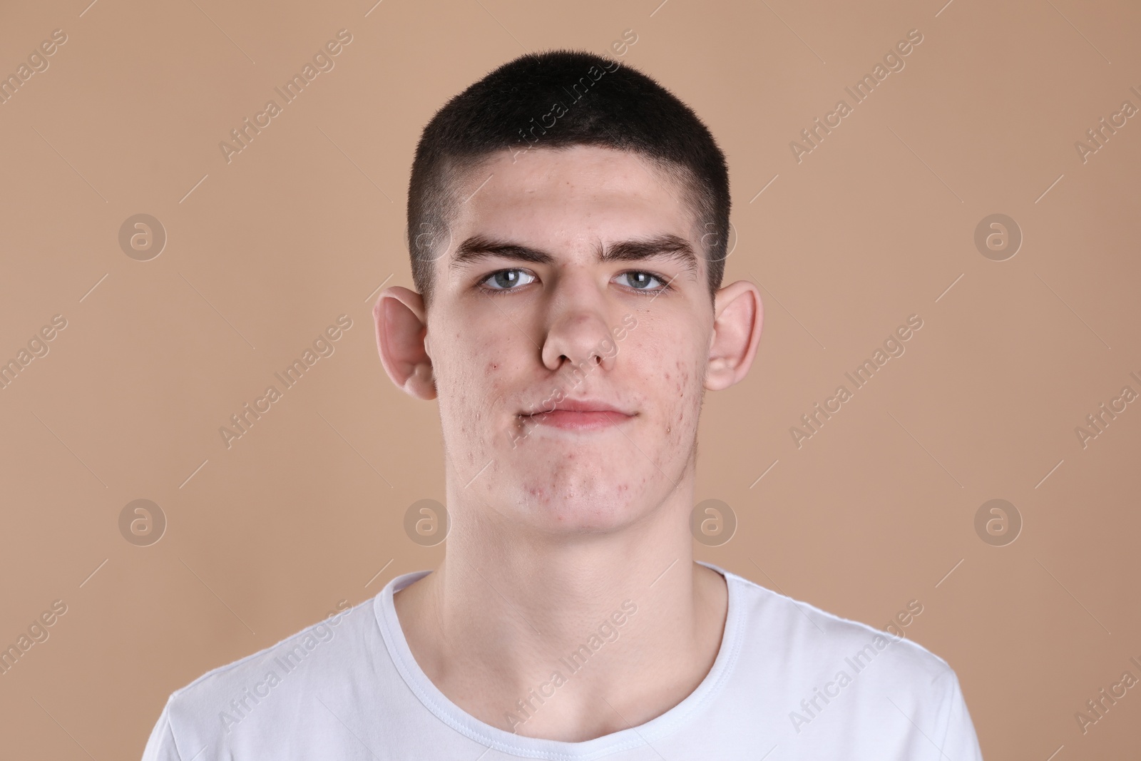Photo of Young man with acne problem on beige background