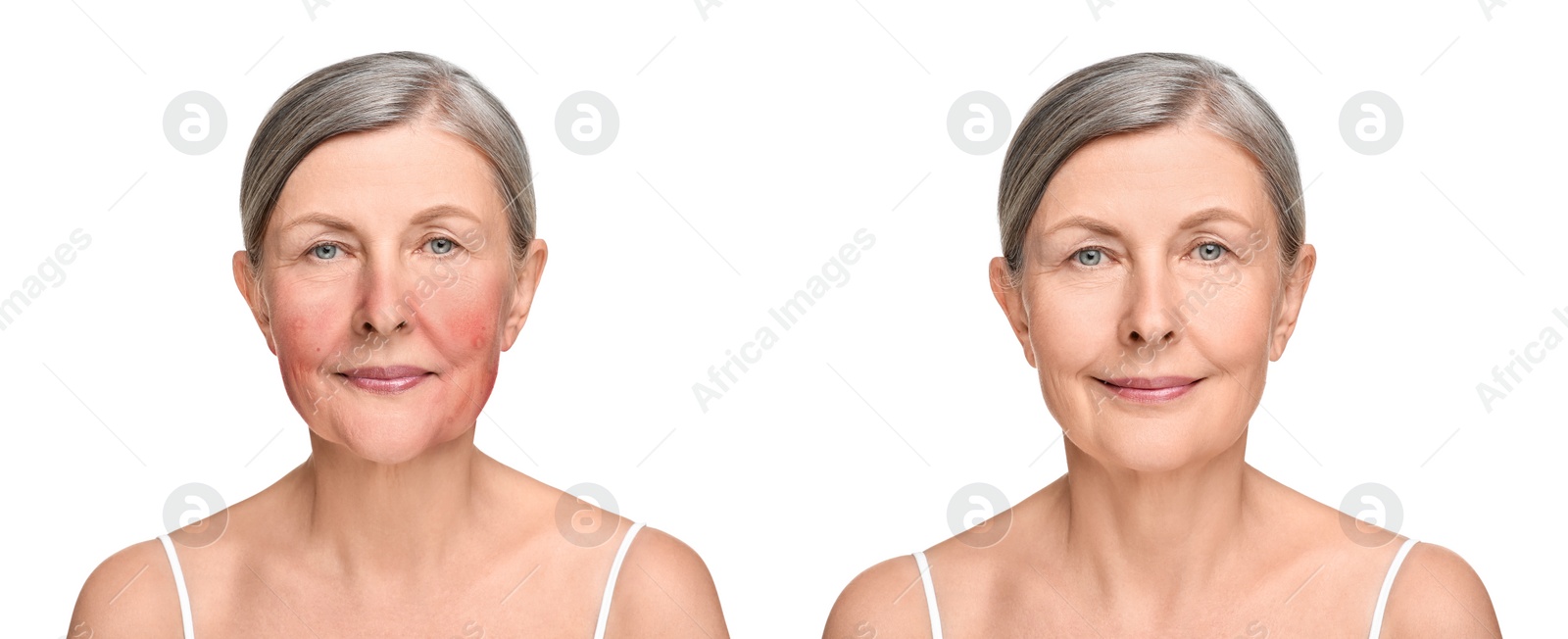 Image of Before and after rosacea treatment. Photos of woman on white background. Collage showing affected and healthy skin