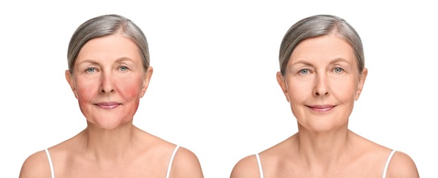 Image of Before and after rosacea treatment. Photos of woman on white background. Collage showing affected and healthy skin