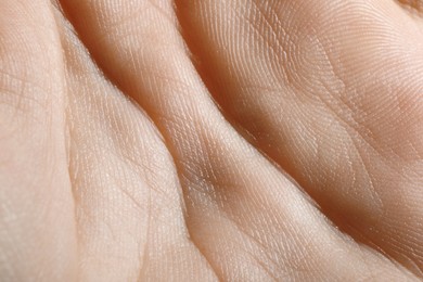 Closeup view of human hand with dry skin