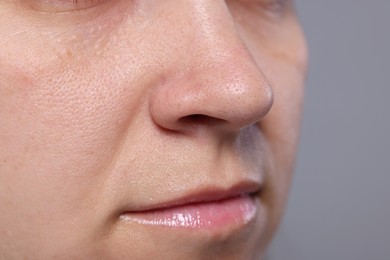 Photo of Closeup view of woman with comedones on her nose against grey background