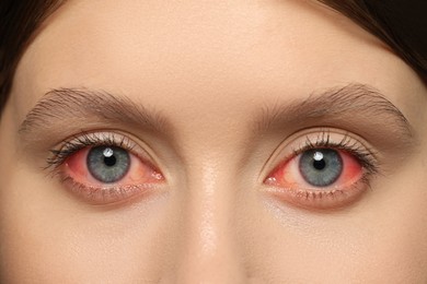 Image of Closeup view of woman with inflamed eyes