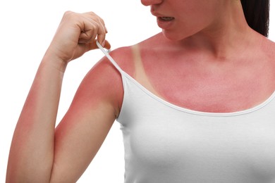 Photo of Woman with sunburned skin on white background, closeup