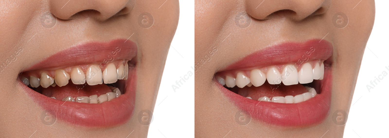 Image of Collage with photos of young woman before and after dental treatment on white background, closeup. Banner design