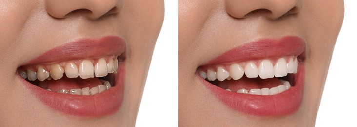 Image of Collage with photos of young woman before and after dental treatment on white background, closeup. Banner design