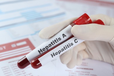 Scientist holding tubes with blood samples for hepatitis virus test against laboratory forms, closeup