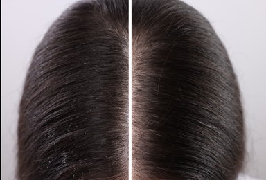 Woman showing hair before and after dandruff treatment on light background, collage