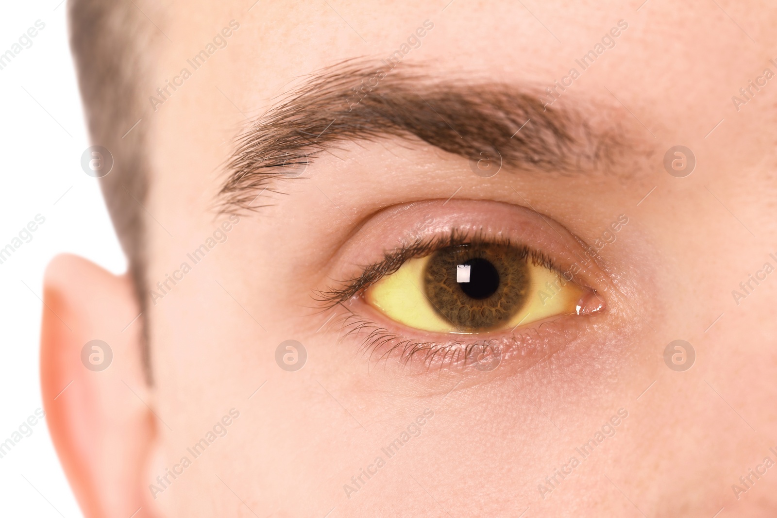 Photo of Man with yellow eyes on white background, closeup. Symptom of hepatitis