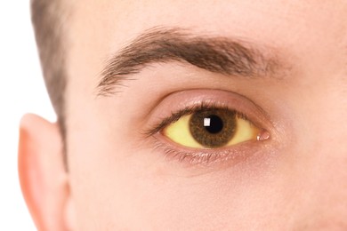 Photo of Man with yellow eyes on white background, closeup. Symptom of hepatitis