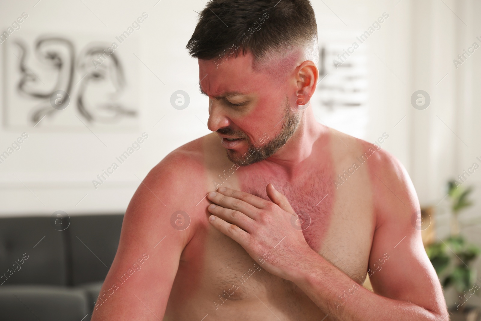 Photo of Man with sunburn on skin at home