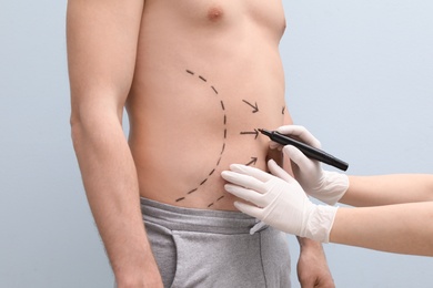 Doctor drawing lines on man's stomach with marker against light background