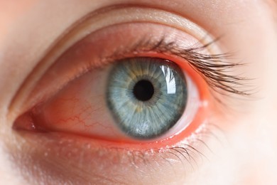 Image of Woman with red eye suffering from conjunctivitis, closeup