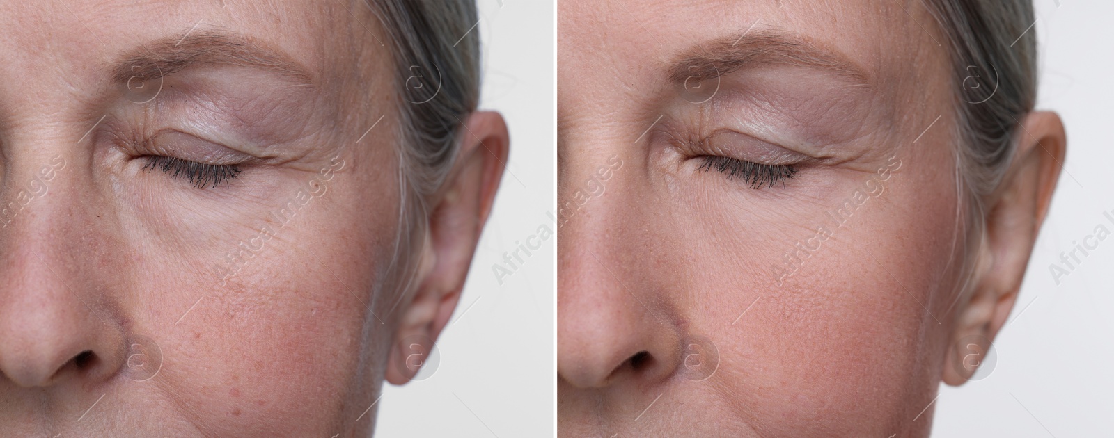 Image of Aging skin changes. Collage with photos of mature woman before and after cosmetic procedure on white background, closeup