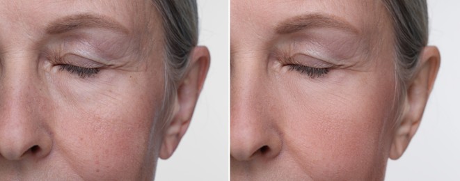 Image of Aging skin changes. Collage with photos of mature woman before and after cosmetic procedure on white background, closeup