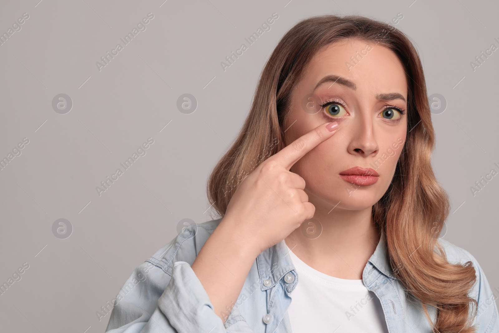 Photo of Woman with yellow eyes on grey background, space for text. Liver problems symptom