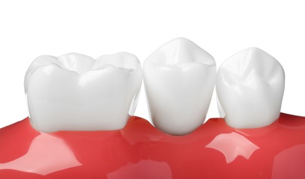 Photo of Educational model of gum with teeth on white background