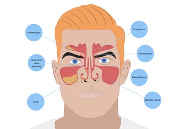 Illustration of  man with healthy and inflammed paranasal sinuses on white background