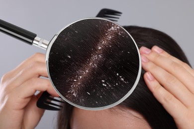 Woman suffering from dandruff on grey background, closeup. View through magnifying glass on hair with flakes