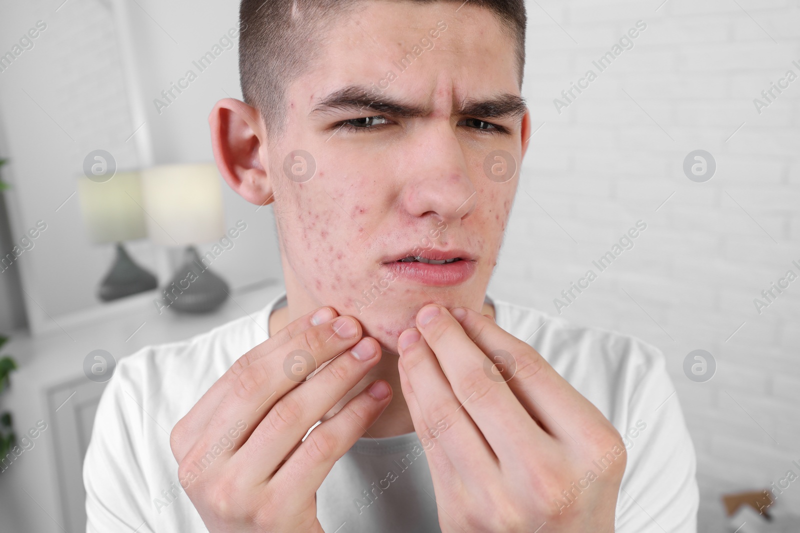 Photo of Upset young man touching pimple on his face indoors. Acne problem