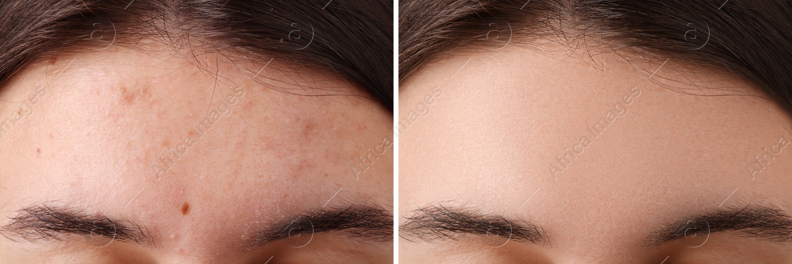 Image of Collage with photos of woman with acne problem before and after treatment, closeup. Banner design