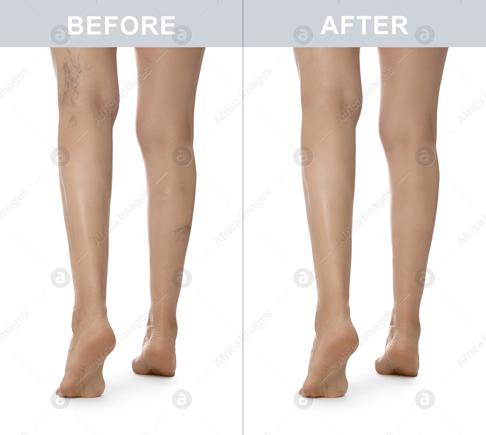 Image of Before and after varicose veins treatment. Collage with photos of woman showing legs on white background, closeup