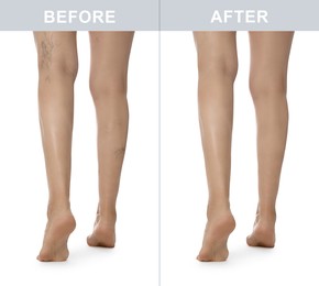 Image of Before and after varicose veins treatment. Collage with photos of woman showing legs on white background, closeup