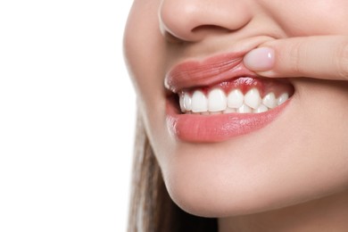 Image of Woman showing inflamed gum on white background, closeup