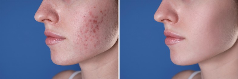 Image of Acne problem. Young woman before and after treatment on blue background, closeup. Collage of photos