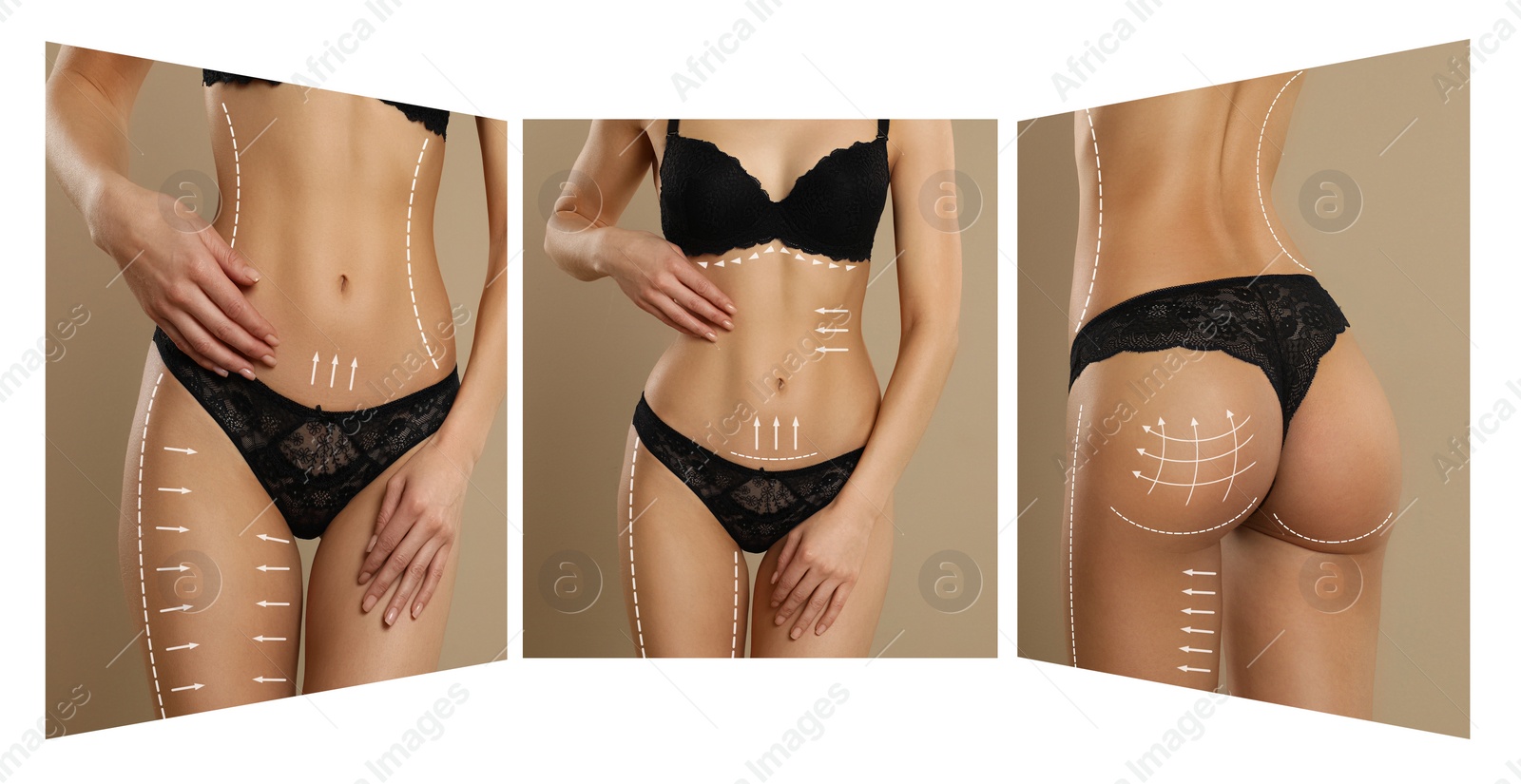 Image of Photos of young woman with marks on body against beige background, collage. Cosmetic surgery concept