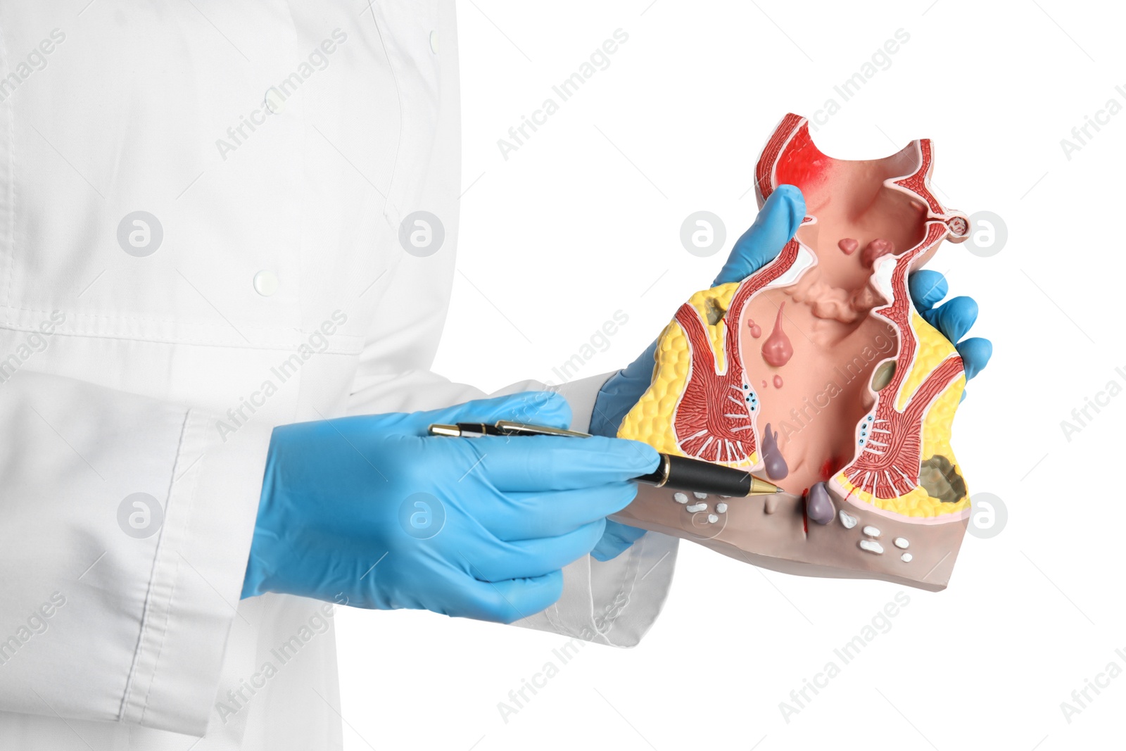 Photo of Doctor pointing at model of unhealthy lower rectum with inflamed vascular structures on white background, closeup. Hemorrhoid problem