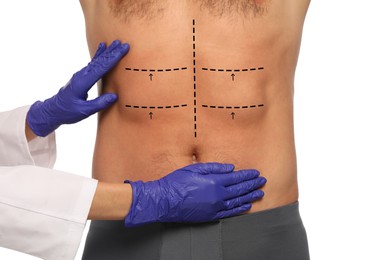 Doctor and patient preparing for cosmetic surgery, white background. Man with markings on his abdomen, closeup