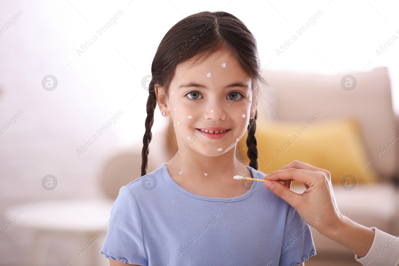 Photo of Mother applying cream onto skin of her daughter with chickenpox at home