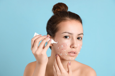 Teen girl with acne problem applying cream on light blue background