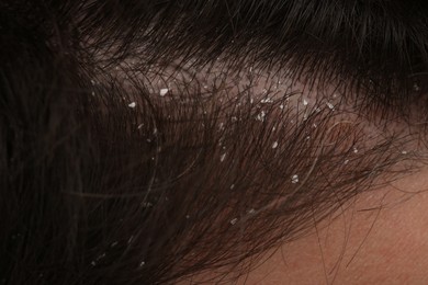 Man with dandruff in his dark hair, closeup