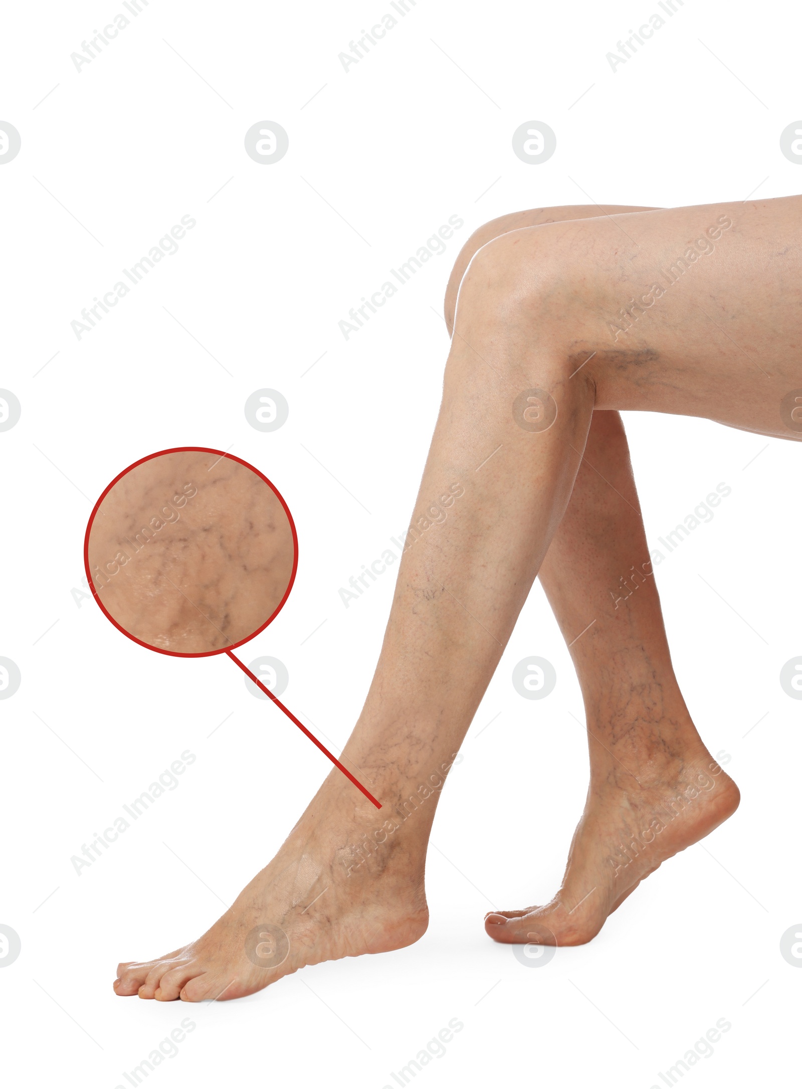 Image of Woman suffering from varicose veins on white background, closeup. Magnified skin surface showing affected area