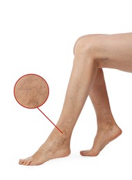 Woman suffering from varicose veins on white background, closeup. Magnified skin surface showing affected area