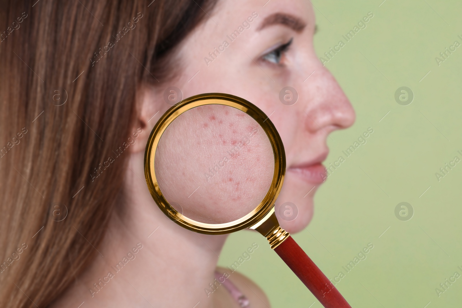 Image of Dermatology. Woman with skin problem on light green background, closeup. View through magnifying glass on acne
