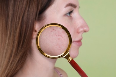 Dermatology. Woman with skin problem on light green background, closeup. View through magnifying glass on acne