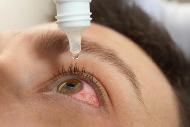 Image of Closeup view of man with inflamed eyes using drops