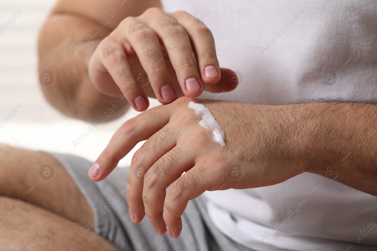 Photo of Man with dry skin applying cream onto his hand, closeup