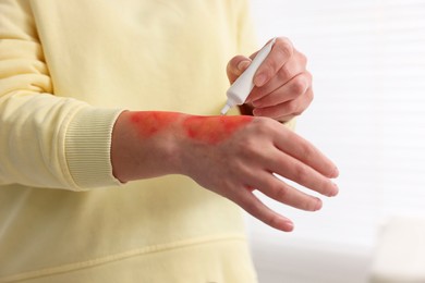 Photo of Woman applying healing cream onto burned hand indoors, closeup