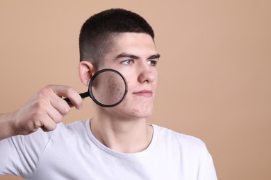Photo of Young man with acne problem holding magnifying glass on beige background. Space for text