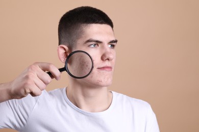 Young man with acne problem holding magnifying glass on beige background. Space for text