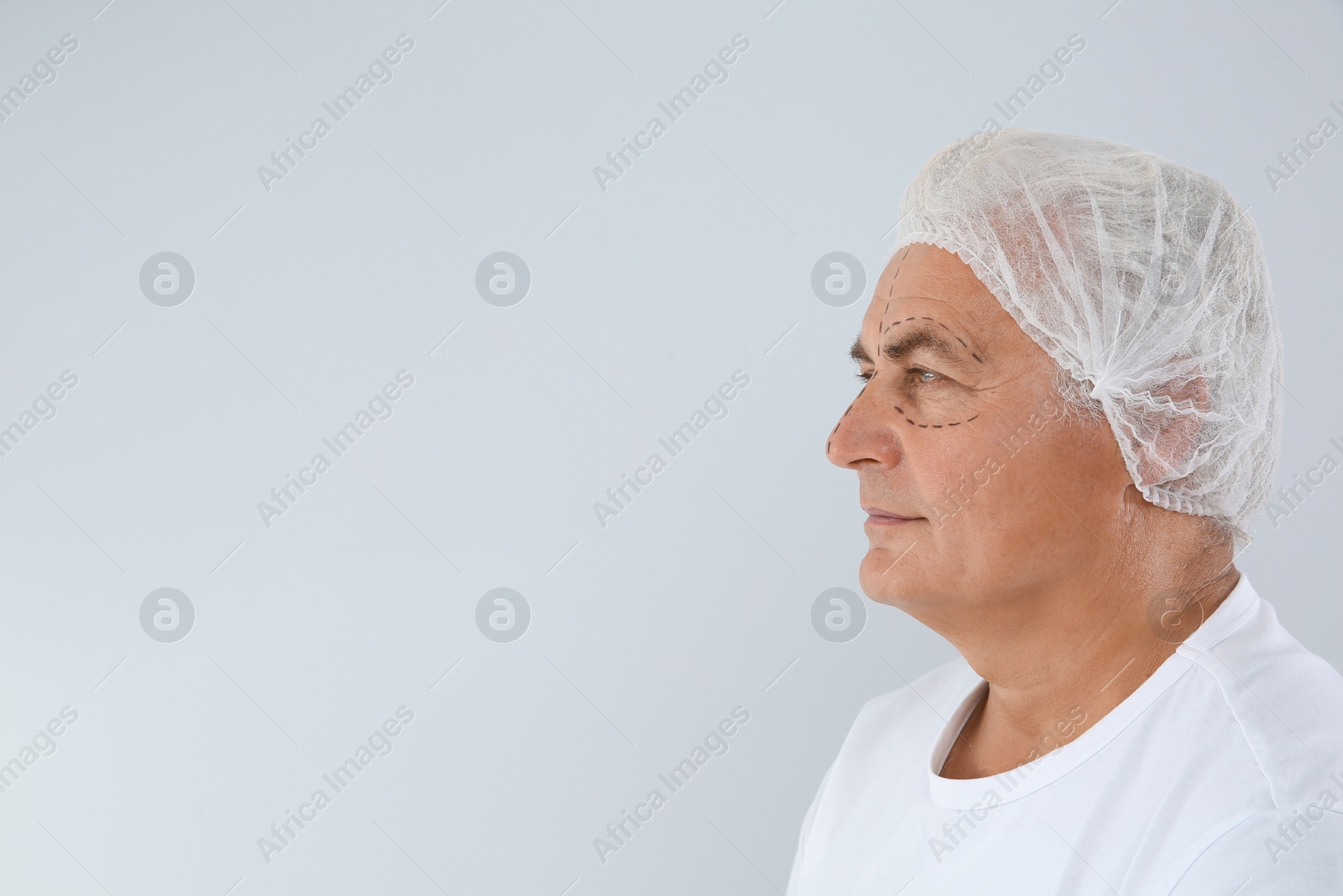 Photo of Portrait of senior man with marks on face preparing for cosmetic surgery against white background. Space for text