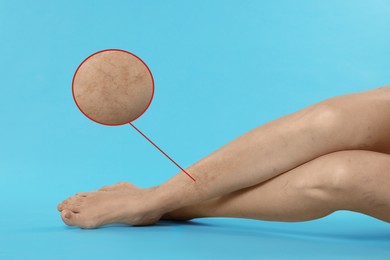 Image of Woman suffering from varicose veins on light blue background, closeup. Magnified skin surface showing affected area