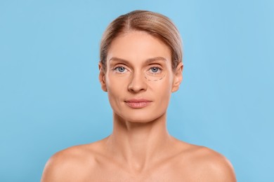 Photo of Portrait of beautiful woman with markings before cosmetic surgery on light blue background