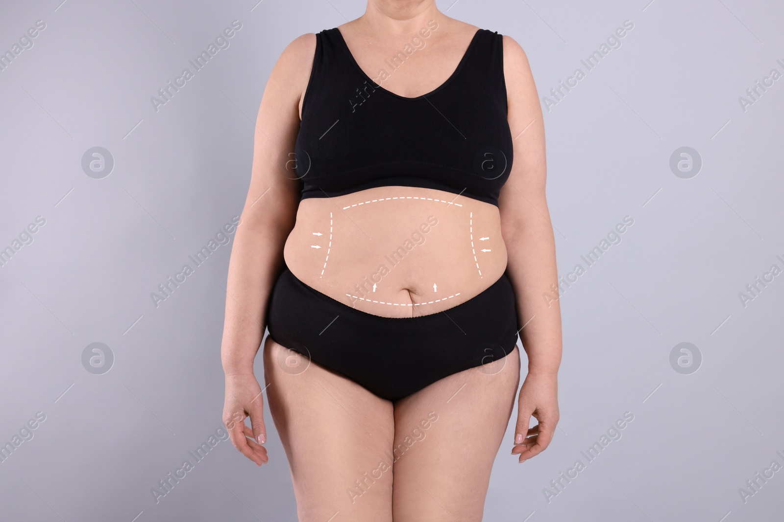 Image of Woman with marks on body before cosmetic surgery operation on light grey background, closeup