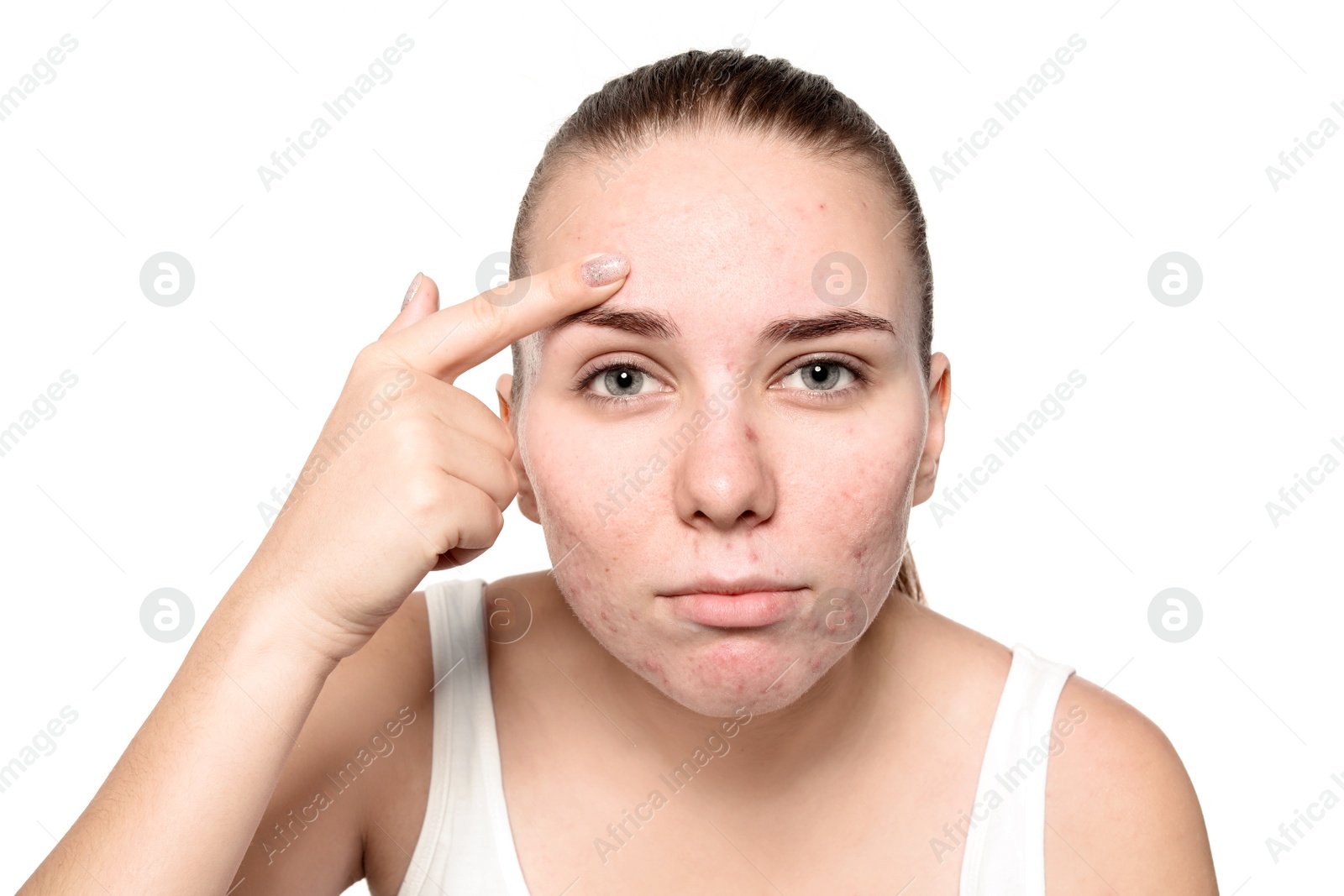 Photo of Young woman with acne problem on white background